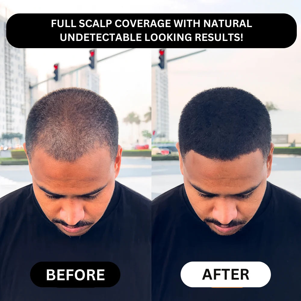 Densifyer™ Hairline Density Filler